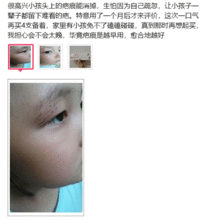 成人痘印视频素材,视频素材中的护肤攻略与修复技巧