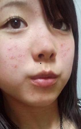 成人脸上长痘的视频,揭秘成人脸上长痘的成因与应对策略